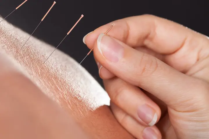 Acupuntura — experiência Catividade